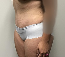 Tummy Tuck After Photo by Kyle Shaddix, MD; Pensacola, FL - Case 36304