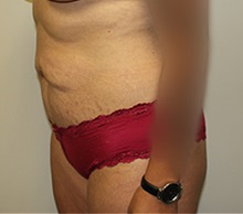 Tummy Tuck Before Photo by Kyle Shaddix, MD; Pensacola, FL - Case 36304