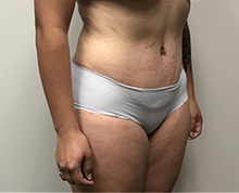 Tummy Tuck After Photo by Kyle Shaddix, MD; Pensacola, FL - Case 36304