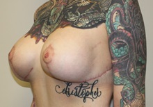 Breast Lift After Photo by Kyle Shaddix, MD; Pensacola, FL - Case 36339