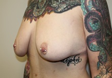 Breast Lift Before Photo by Kyle Shaddix, MD; Pensacola, FL - Case 36339