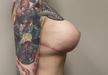 Breast Lift After Photo by Kyle Shaddix, MD; Pensacola, FL - Case 36339