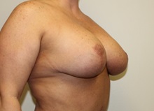 Breast Lift After Photo by Kyle Shaddix, MD; Pensacola, FL - Case 36340