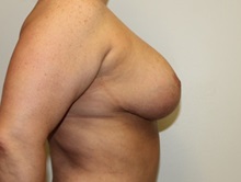 Breast Lift After Photo by Kyle Shaddix, MD; Pensacola, FL - Case 36340
