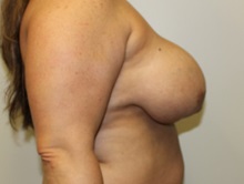 Breast Lift Before Photo by Kyle Shaddix, MD; Pensacola, FL - Case 36340