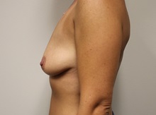 Breast Lift Before Photo by Kyle Shaddix, MD; Pensacola, FL - Case 36392