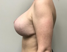 Breast Lift After Photo by Kyle Shaddix, MD; Pensacola, FL - Case 36394