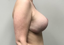 Breast Lift After Photo by Kyle Shaddix, MD; Pensacola, FL - Case 36394