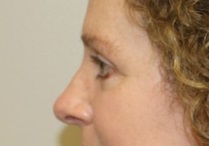 Eyelid Surgery After Photo by Kyle Shaddix, MD; Pensacola, FL - Case 36395