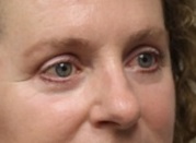 Eyelid Surgery After Photo by Kyle Shaddix, MD; Pensacola, FL - Case 36395