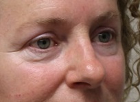 Eyelid Surgery Before Photo by Kyle Shaddix, MD; Pensacola, FL - Case 36395