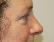 Eyelid Surgery Before Photo by Kyle Shaddix, MD; Pensacola, FL - Case 36395