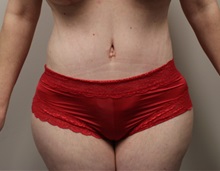 Tummy Tuck After Photo by Kyle Shaddix, MD; Pensacola, FL - Case 37333