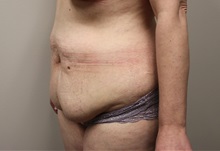 Tummy Tuck Before Photo by Kyle Shaddix, MD; Pensacola, FL - Case 37333