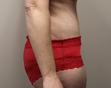 Tummy Tuck After Photo by Kyle Shaddix, MD; Pensacola, FL - Case 37333