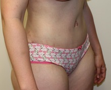 Tummy Tuck After Photo by Kyle Shaddix, MD; Pensacola, FL - Case 37334