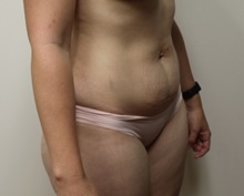 Tummy Tuck Before Photo by Kyle Shaddix, MD; Pensacola, FL - Case 37334