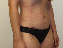 Tummy Tuck After Photo by Kyle Shaddix, MD; Pensacola, FL - Case 37337