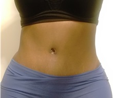 Tummy Tuck After Photo by Kyle Shaddix, MD; Pensacola, FL - Case 37340
