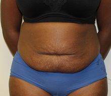 Tummy Tuck Before Photo by Kyle Shaddix, MD; Pensacola, FL - Case 37340