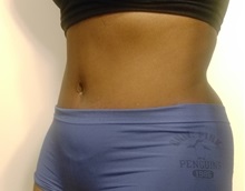 Tummy Tuck After Photo by Kyle Shaddix, MD; Pensacola, FL - Case 37340