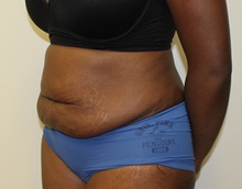 Tummy Tuck Before Photo by Kyle Shaddix, MD; Pensacola, FL - Case 37340