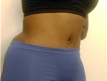 Tummy Tuck After Photo by Kyle Shaddix, MD; Pensacola, FL - Case 37340