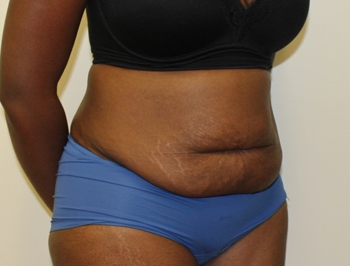 quando assumere acetil l carnitina C-Section Shelf: What It Is & How to Get Rid of It main image 0