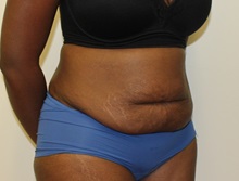 Tummy Tuck Before Photo by Kyle Shaddix, MD; Pensacola, FL - Case 37340