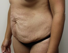 Tummy Tuck Before Photo by Kyle Shaddix, MD; Pensacola, FL - Case 37342