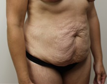 Tummy Tuck Before Photo by Kyle Shaddix, MD; Pensacola, FL - Case 37342