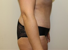 Tummy Tuck After Photo by Kyle Shaddix, MD; Pensacola, FL - Case 37342