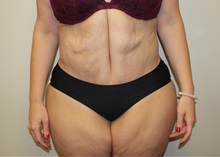 Tummy Tuck After Photo by Kyle Shaddix, MD; Pensacola, FL - Case 37345