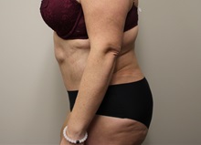 Tummy Tuck After Photo by Kyle Shaddix, MD; Pensacola, FL - Case 37345
