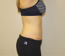 Tummy Tuck After Photo by Kyle Shaddix, MD; Pensacola, FL - Case 37372