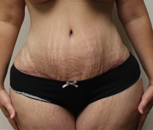 Tummy Tuck After Photo by Kyle Shaddix, MD; Pensacola, FL - Case 37375