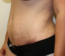 Tummy Tuck After Photo by Kyle Shaddix, MD; Pensacola, FL - Case 37375