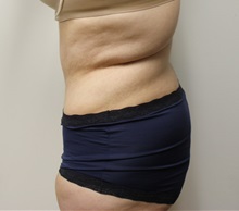 Tummy Tuck After Photo by Kyle Shaddix, MD; Pensacola, FL - Case 37376