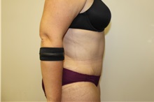 Tummy Tuck After Photo by Kyle Shaddix, MD; Pensacola, FL - Case 37379