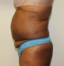 Tummy Tuck Before Photo by Kyle Shaddix, MD; Pensacola, FL - Case 37380