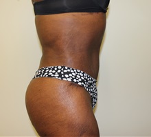Tummy Tuck After Photo by Kyle Shaddix, MD; Pensacola, FL - Case 37380