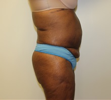 Tummy Tuck Before Photo by Kyle Shaddix, MD; Pensacola, FL - Case 37380