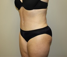 Tummy Tuck After Photo by Kyle Shaddix, MD; Pensacola, FL - Case 37381