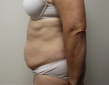 Tummy Tuck Before Photo by Kyle Shaddix, MD; Pensacola, FL - Case 37381