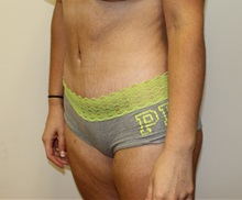 Tummy Tuck After Photo by Kyle Shaddix, MD; Pensacola, FL - Case 37386