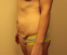 Tummy Tuck Before Photo by Kyle Shaddix, MD; Pensacola, FL - Case 37386