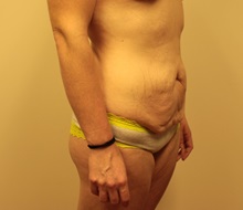 Tummy Tuck Before Photo by Kyle Shaddix, MD; Pensacola, FL - Case 37386