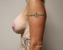 Breast Lift After Photo by Kyle Shaddix, MD; Pensacola, FL - Case 37435