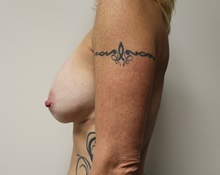 Breast Lift Before Photo by Kyle Shaddix, MD; Pensacola, FL - Case 37435