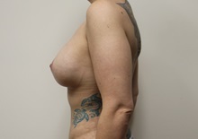 Breast Lift After Photo by Kyle Shaddix, MD; Pensacola, FL - Case 37436